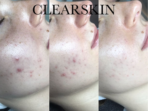 clearskin-huidinstituut-acne-resultaat-onbekend-2