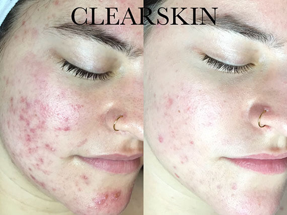 clearskin-huidinstituut-acne-resultaat-onbekend