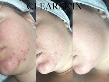 clearskin-huidinstituut-acne-resultaat-steffi